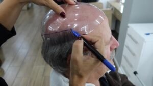 Protese capilar para homens com calvice