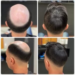 Capilaris protese para jovens com calvice
